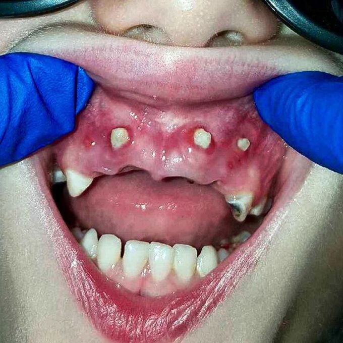 Retarded Teethgrowth in Childhood 
