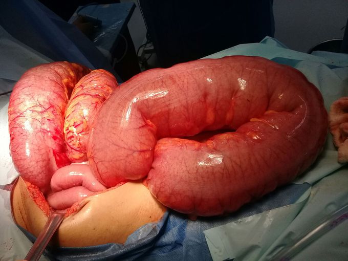 Megacolon