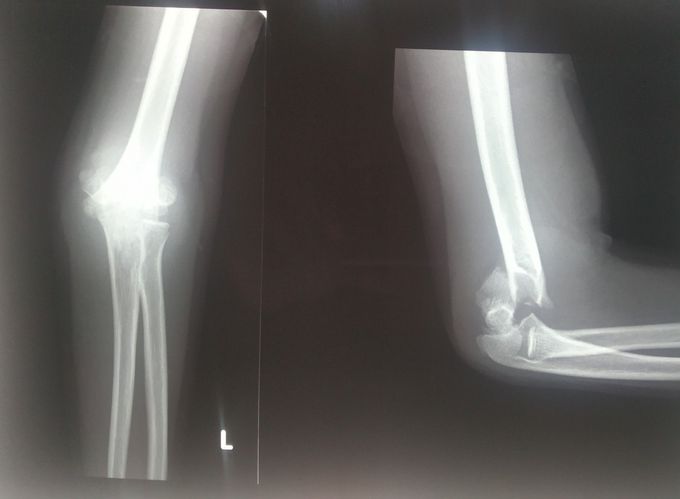 supracondylar fracture