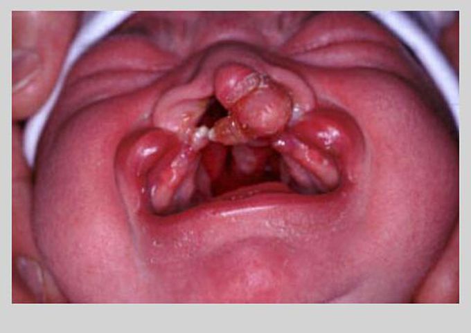 Cleft lip and palate