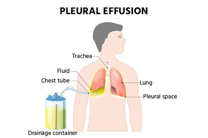 Causes of pleural effusion