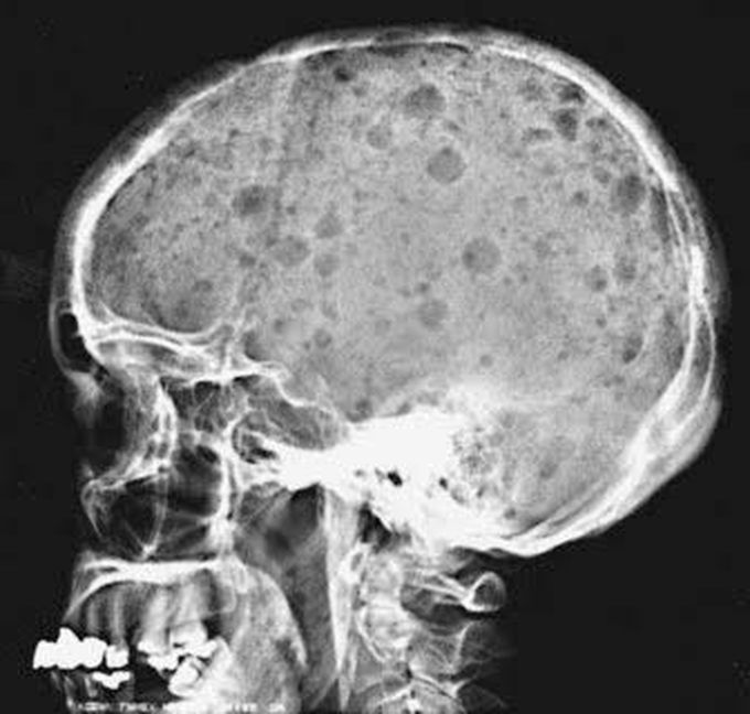 X-ray