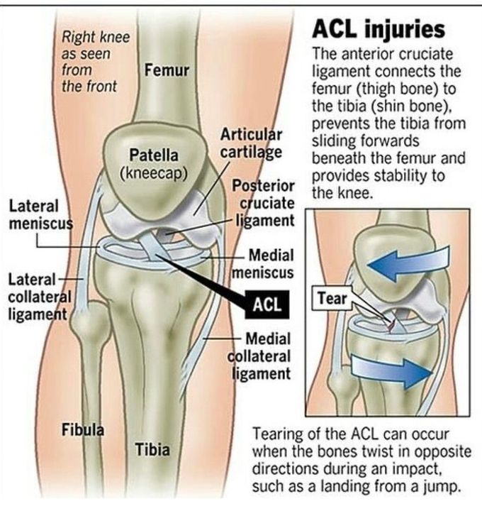 ACL Injuries