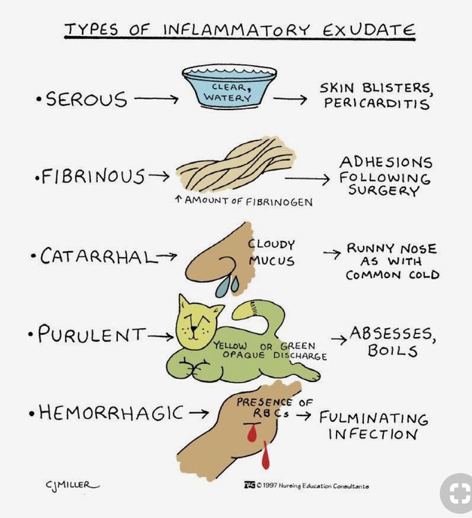 Inflammatory exudates