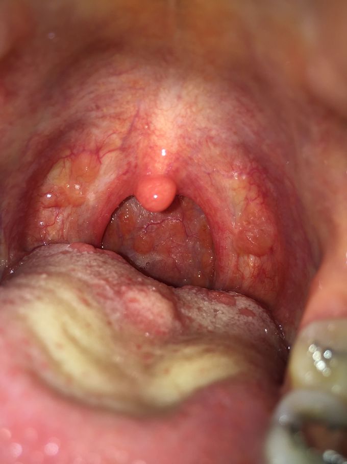 Tonsillitis
