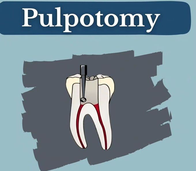 PULPOTOMY