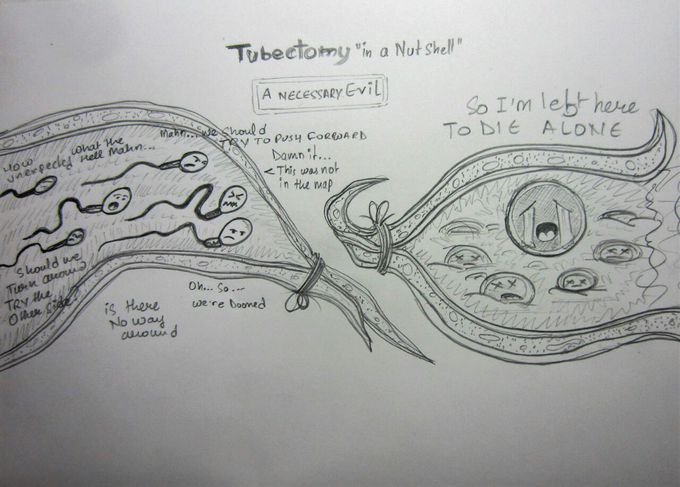 TUBECTOMY IN a NUTSHELL