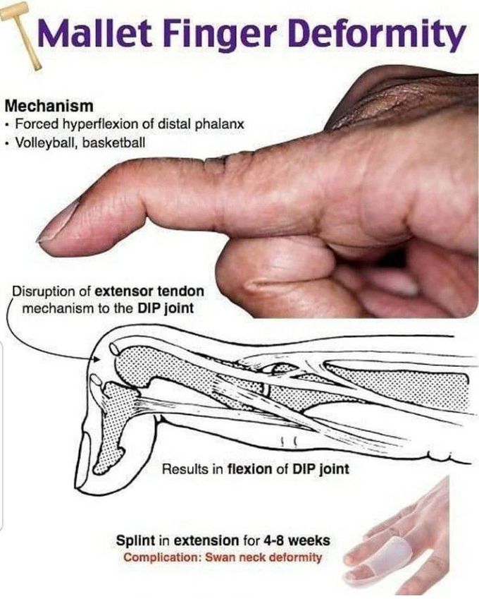 Mallet finger deformity