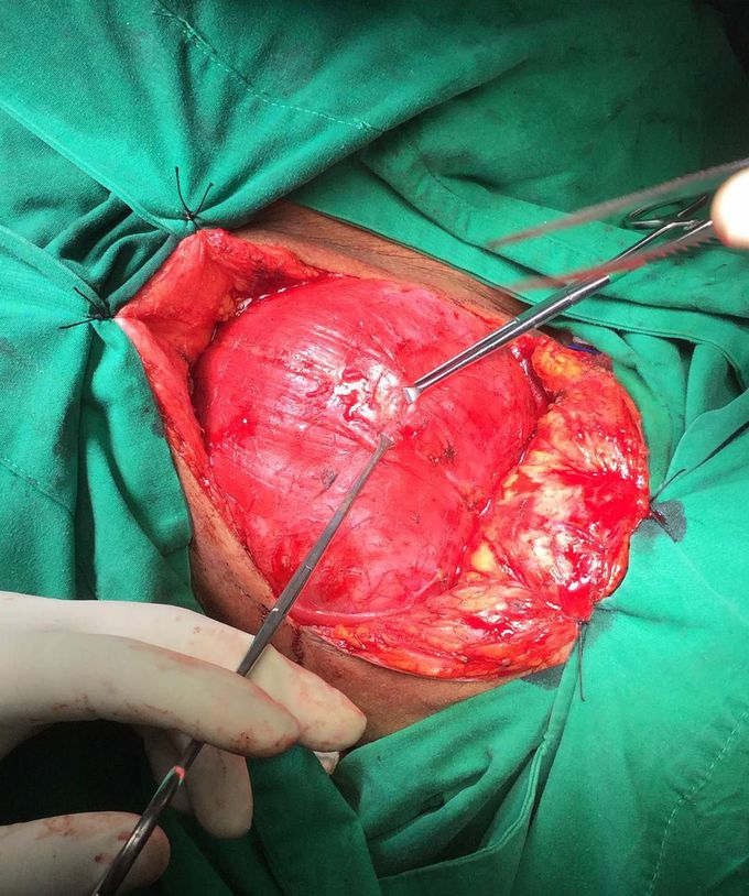 This is a plane as midline for divided the strap muscles to reach the true capsule of thyroid 