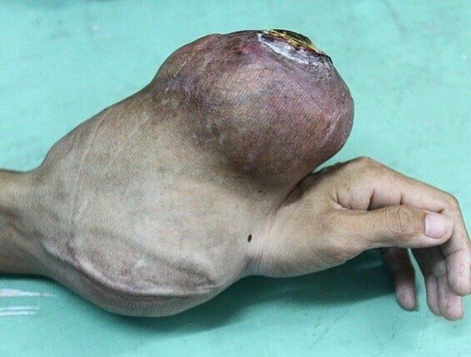 Untreated giant cell tumor of the lower arm! 