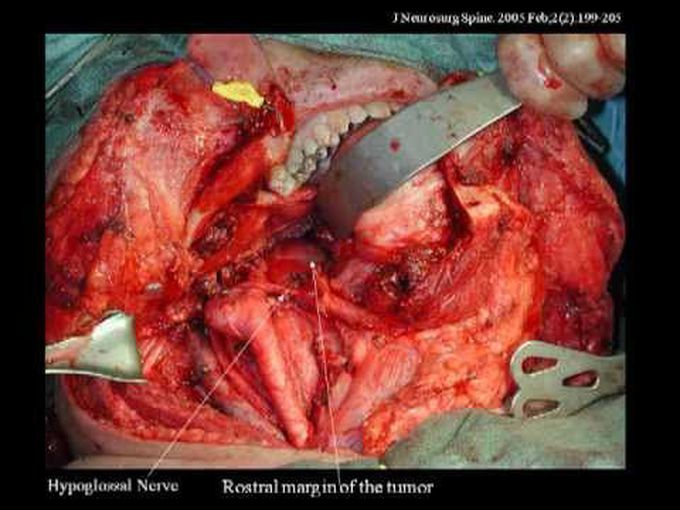 Advances in Radical Surgical Resection of Primary Spinal Tumors