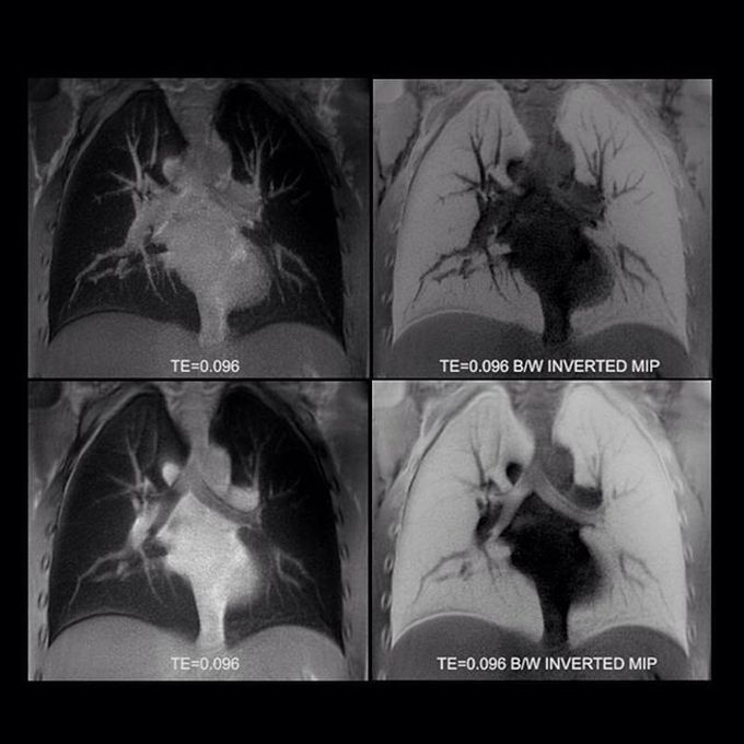 Ultrashort TE (UTE) dedicated MR sequence for lung imaging