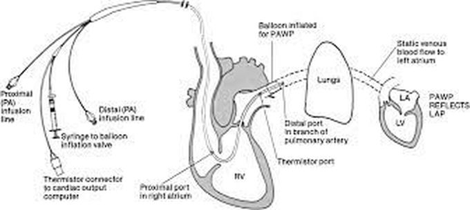 Pulmonary artery catheter; indications and use by nursesnote