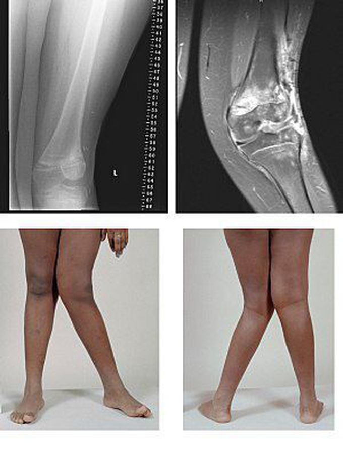 A very severe case of genu valgum of the left knee following bone cancer treatment