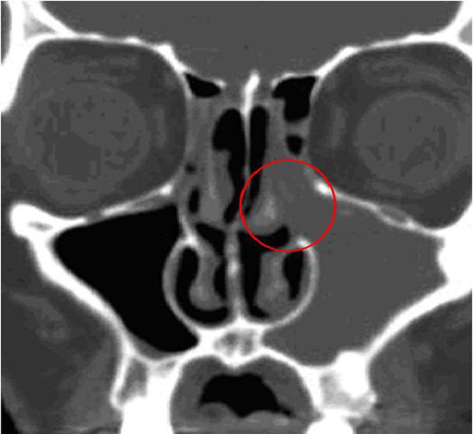 Sinusitis