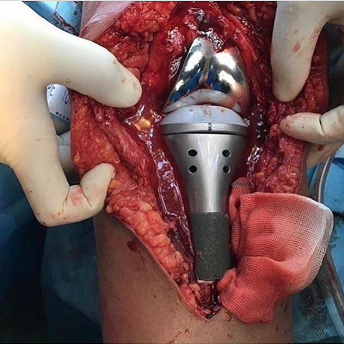 Intra operative pic taken of a knee replacement. This patient required the prosthesis due a tibial tumor!