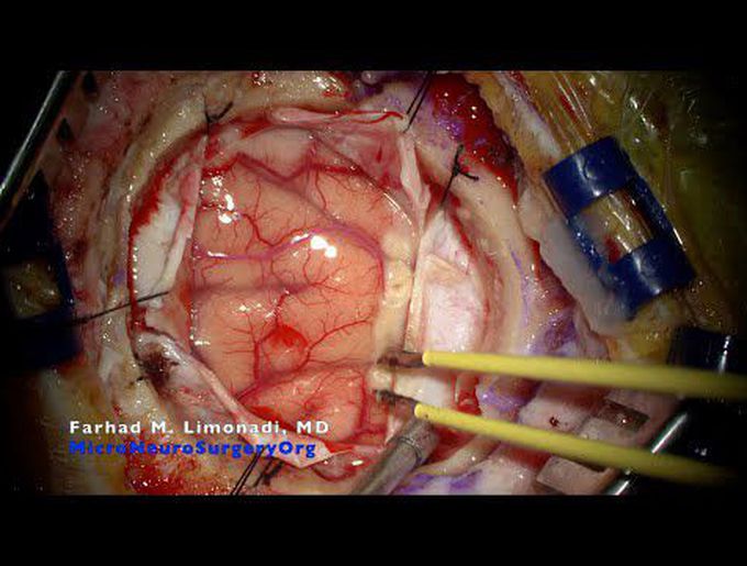 Brain tumor (metastatic) removal after failing stereotactic radiosurgery (radiotherapy).