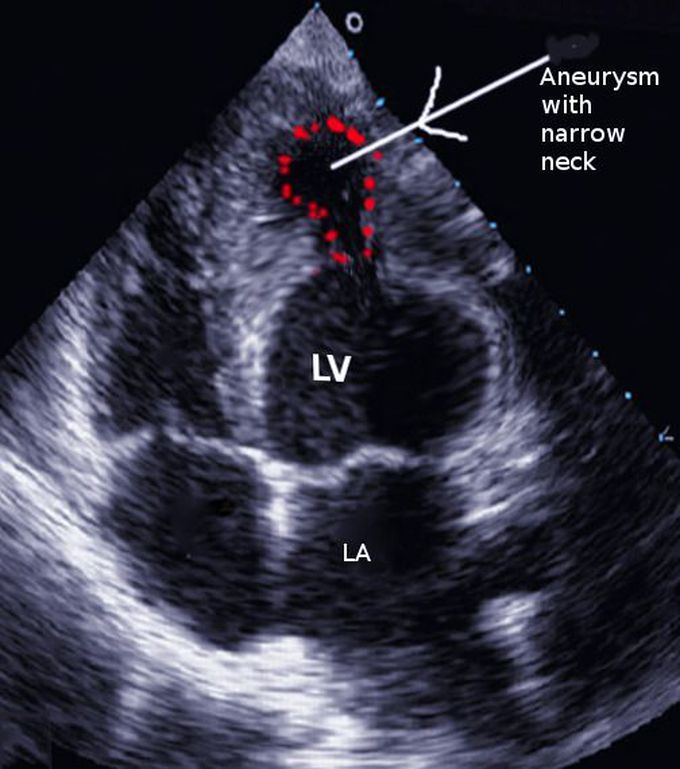 Ventricular Aneurysm in Post-Myocardial Patients
