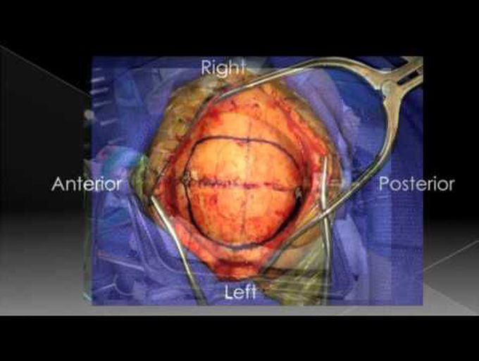 Endoscopic-assisted post. interhemi retrocallosal transfalcine approach for falcotentorial ...