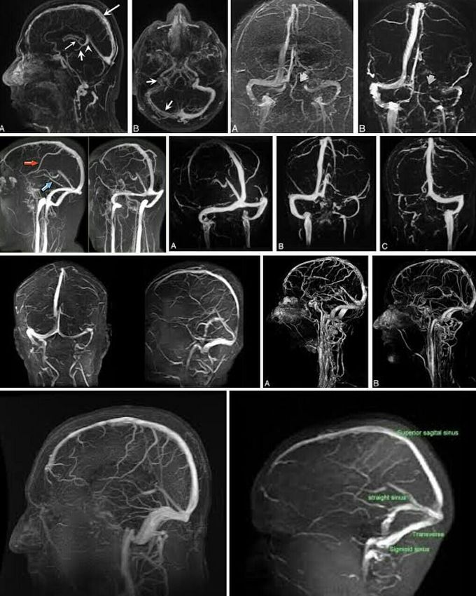 MRV stands for magnetic resonance venography