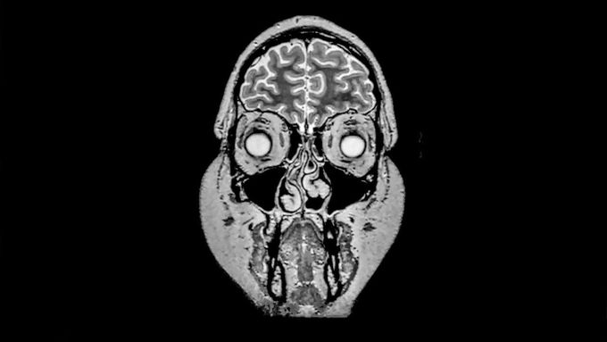 A Mom Drank 3 Gallons Water In 2 Hours. This is What Happened to Her Brain.