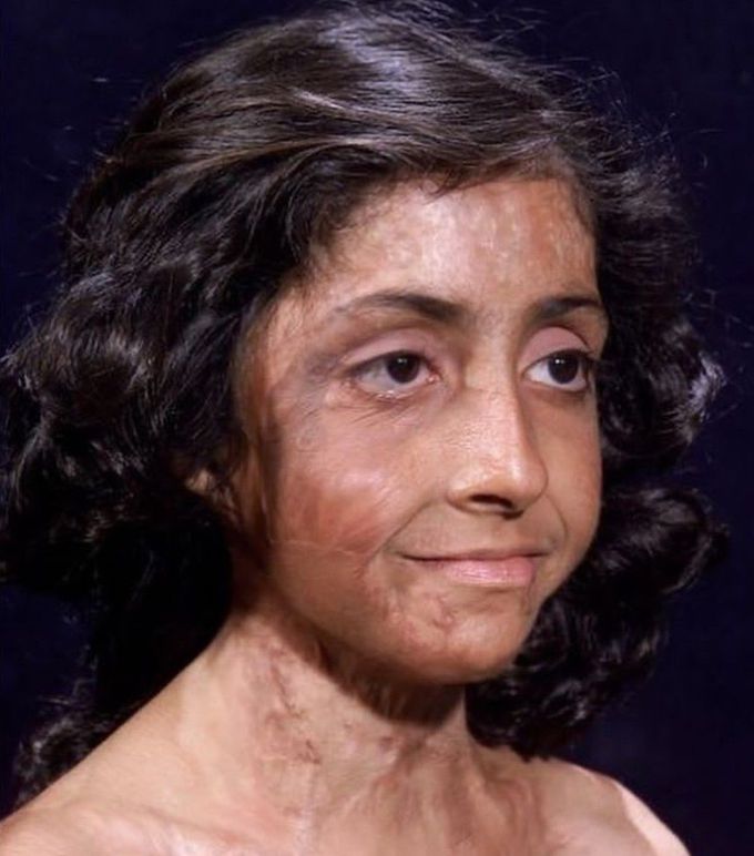 Facial Reconstruction of a Burn Victim- II