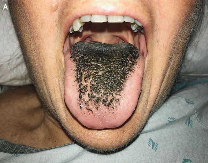 Symptoms of Hairy tongue
