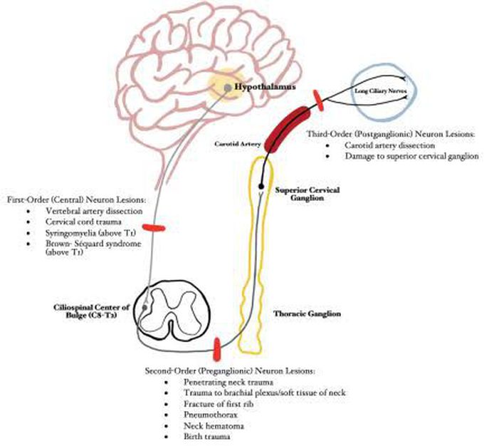 Horners Syndrome causes