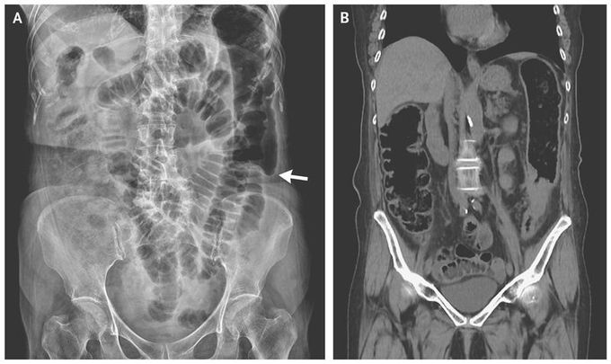 Colon Cutoff Sign