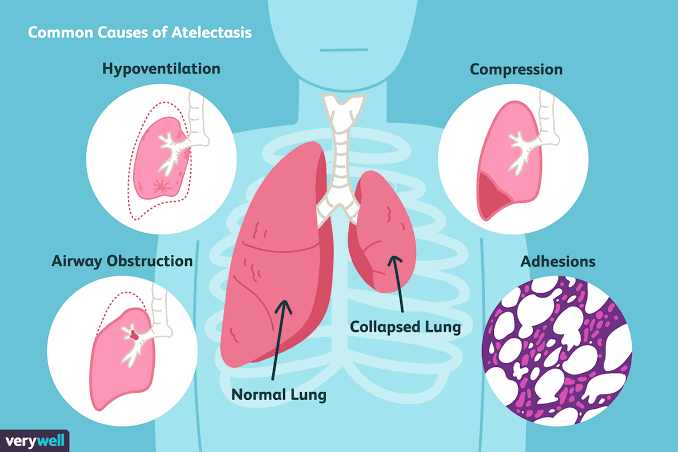 Atelectasis symptoms - MEDizzy