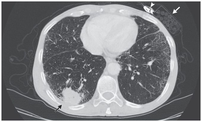 Squamous-Cell Carcinoma of the Lung
