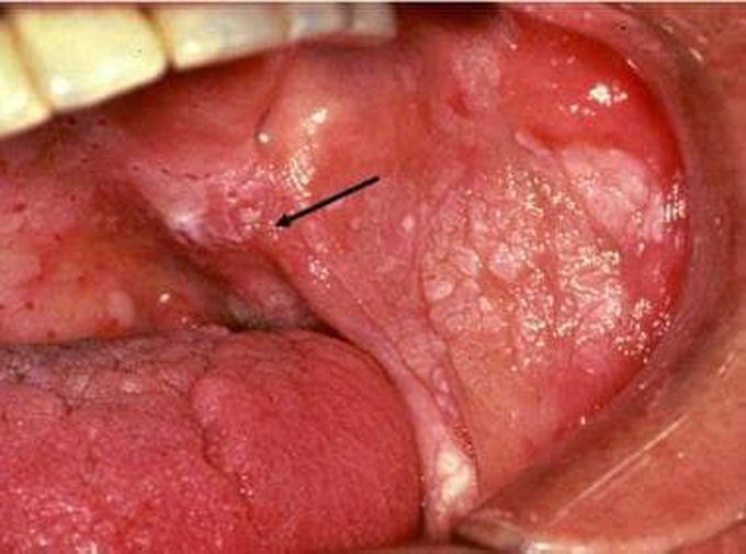 Erythroleukoplakia