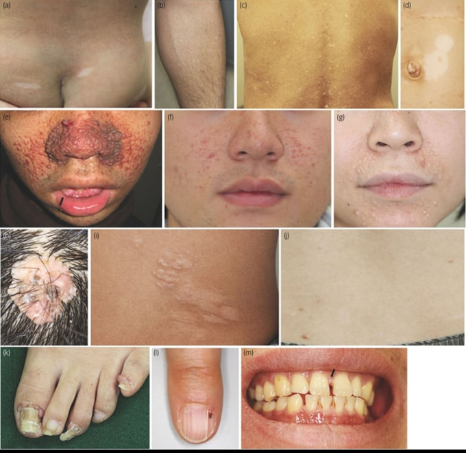 Can anyone. name all important skin changes which are seen in this disease???