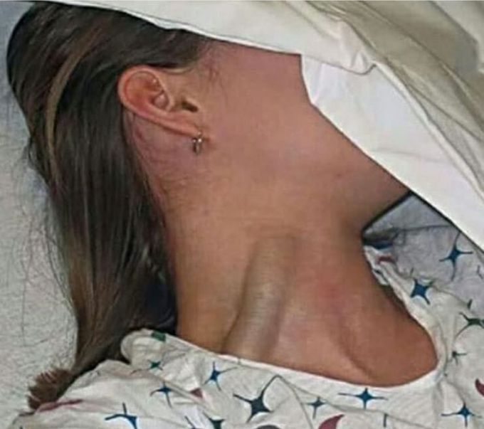 Jugular Venous Distension (JVD) in a young woman
.