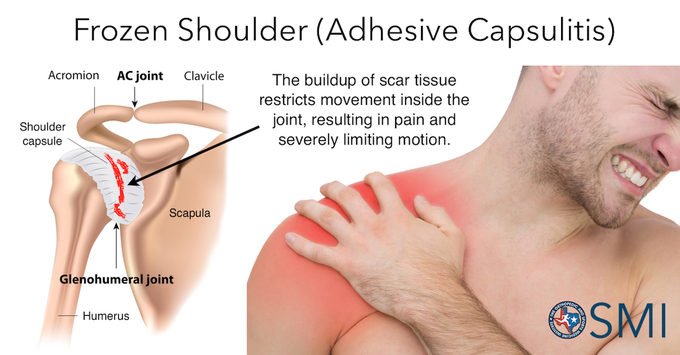 Frozen Shoulder Adhesive Capsulitis