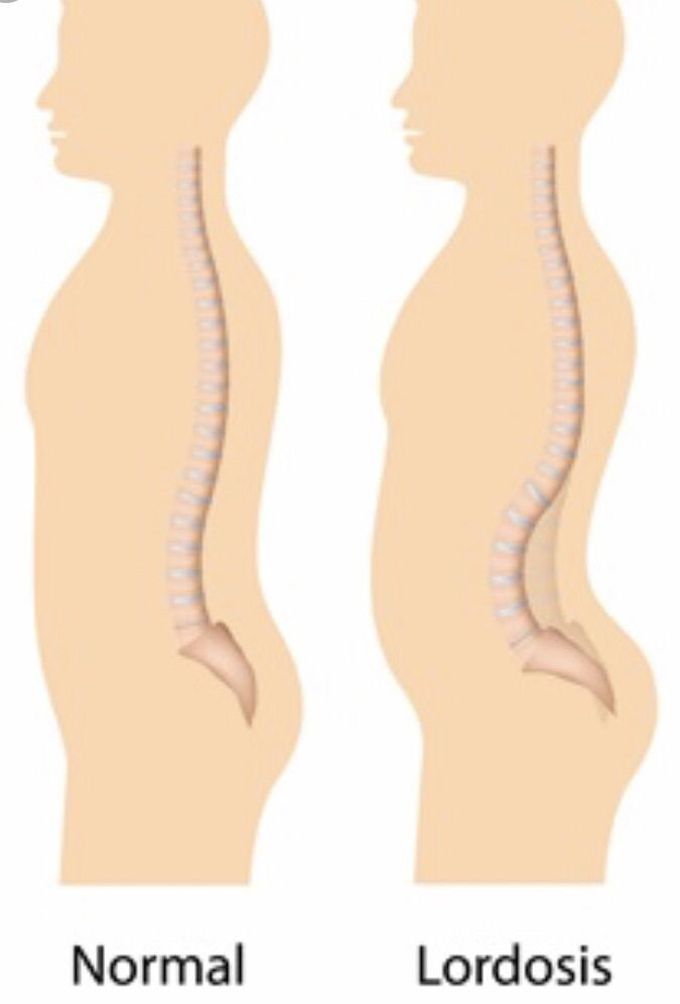 Lordosis vs. kyphosis