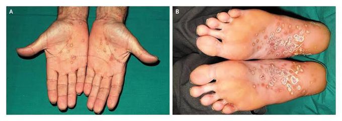 Keratodermia blennorrhagicum