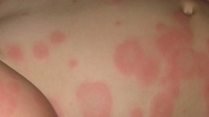 Erythema multiforme