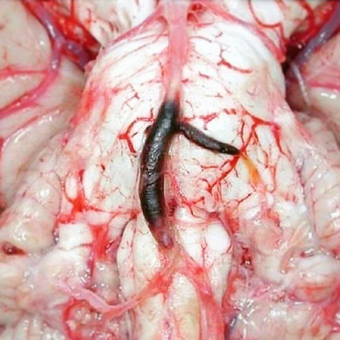 Stroke