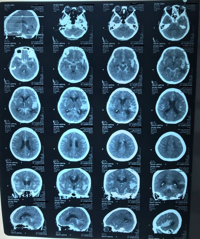 Head CT of patient with moderate head injury