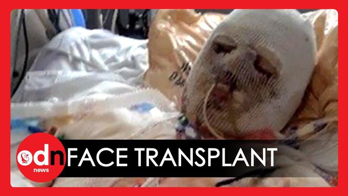 World's First Face and Hand Transplant Surgery