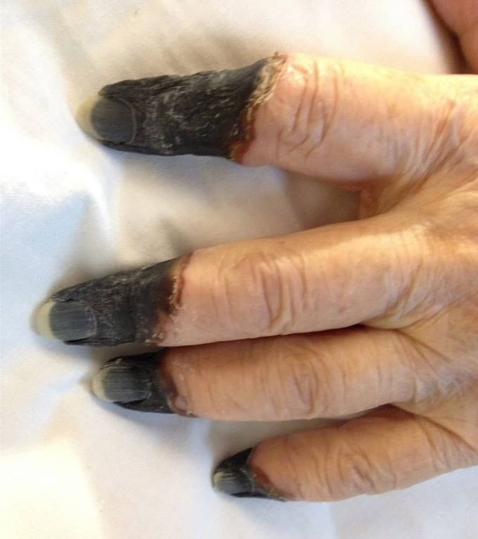 ‌Cold Agglutinin Disease