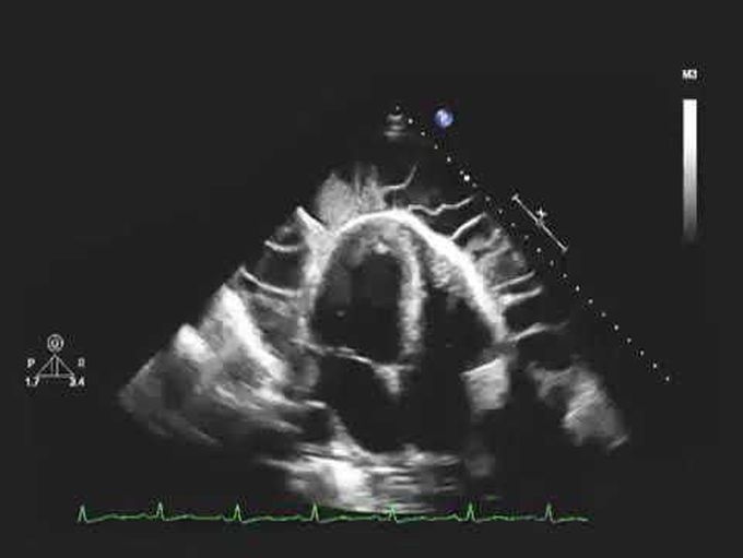 Echocardiogram of a Patient with Uremic Pericarditis  And Uremic Pericarditis
