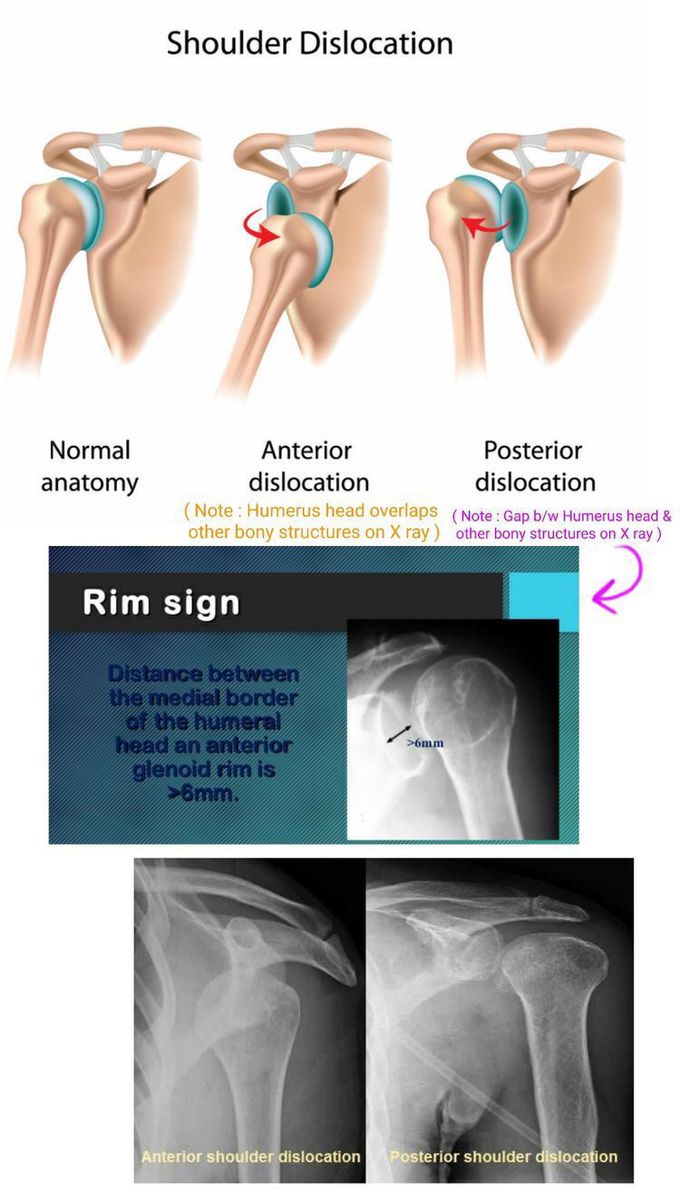 Shoulder dislocation