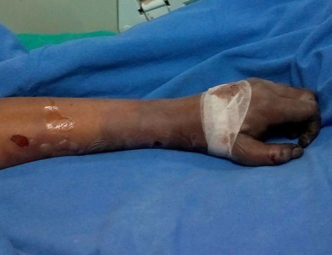 This is a complications of some intervention done to this patient in icu? Comment about the intervention 