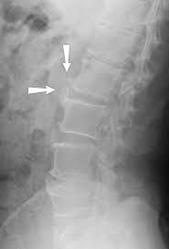 Spondylosis treatment