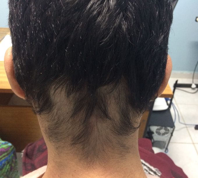Hair loss