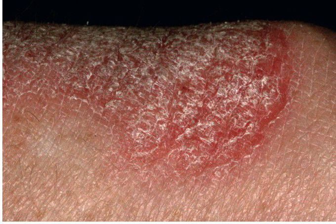 Psoriasis