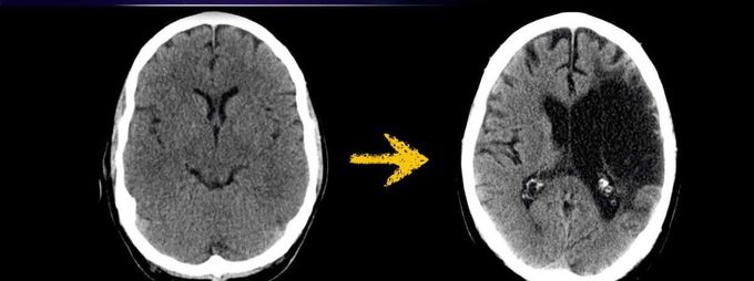 CerebroVascular Accident