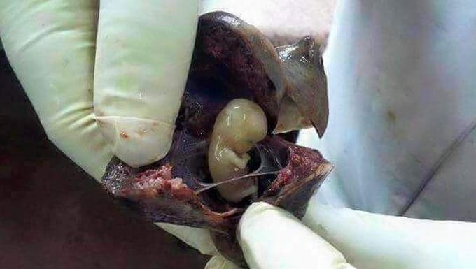 Ectopic pregnancy
